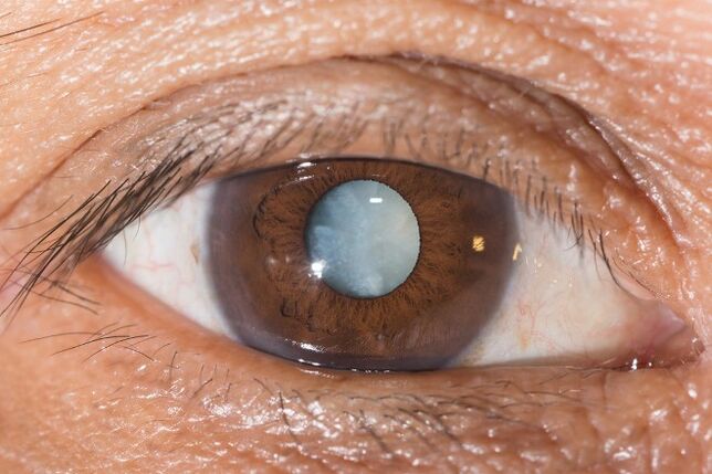 In case of cataracts, exercises to improve vision are indicated.