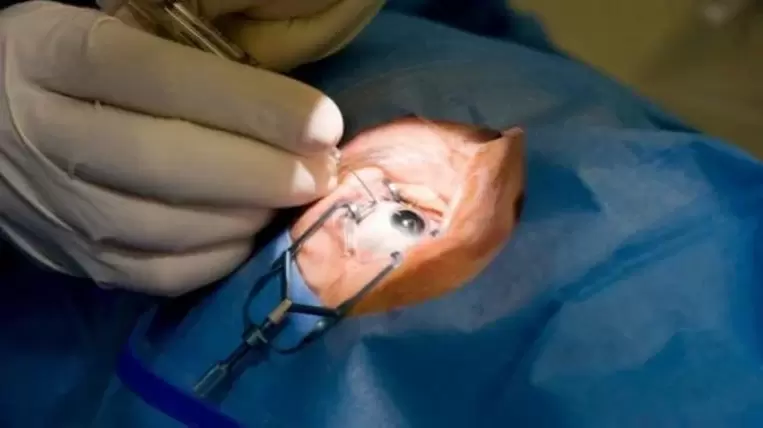 Vitrectomy – removal of the vitreous body from the eye